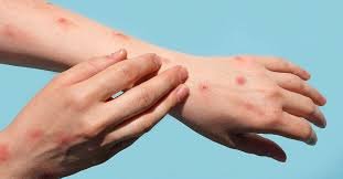 "A microscopic image of the MPox virus, with a red and orange color scheme to represent the virus's structure"