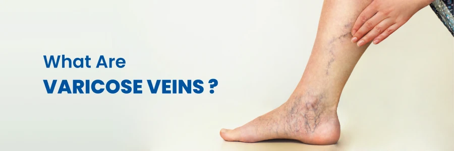 varicose veins